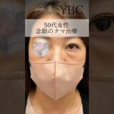 50代女性念願のクマ治療#美容 #整形 #目の下のクマ #目の下のたるみ取り #ダウンタイム ほぼ0#整形外科 #若返り #クマ取り #クマ整形#健康 #ダイエット
