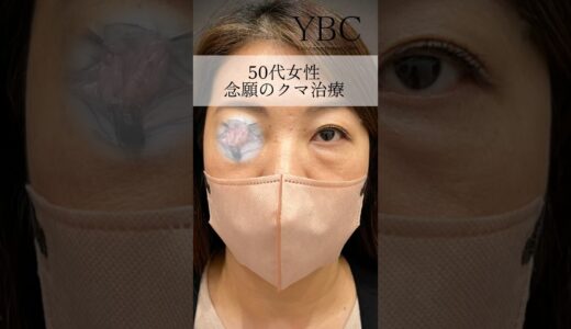 50代女性念願のクマ治療#美容 #整形 #目の下のクマ #目の下のたるみ取り #ダウンタイム ほぼ0#整形外科 #若返り #クマ取り #クマ整形#健康 #ダイエット