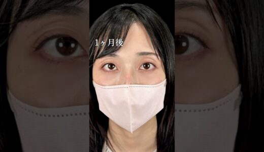 【クマ取り】お目元から若返る！#shorts #美容整形 #美容 #整形