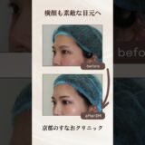 二重全切開@sunaoclinic  #すなおクリニック #美容整形 #二重