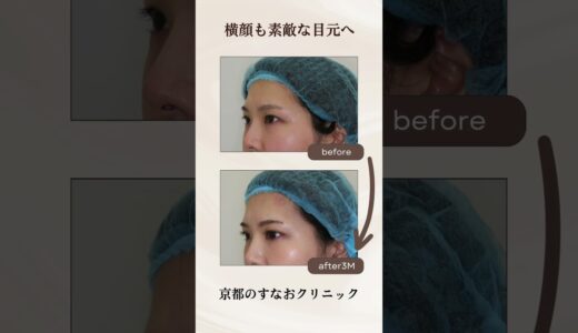 二重全切開@sunaoclinic  #すなおクリニック #美容整形 #二重