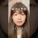 鼻フル整形すると、、😳😳#astrabeautyclinic  #アストラビューティークリニック #塩満恵子 #鼻整形 #美容整形 #忘れ鼻