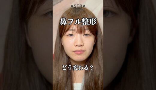 鼻フル整形すると、、😳😳#astrabeautyclinic  #アストラビューティークリニック #塩満恵子 #鼻整形 #美容整形 #忘れ鼻