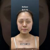 【小顔整形】いらない脂肪を排除し、額・こめかみに注入したことで卵輪郭に！ #shorts