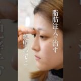 脂肪注入で治す絶壁おでこ#美容整形 #脂肪注入 #名古屋