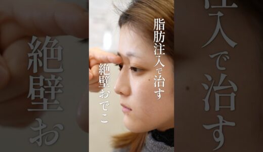 脂肪注入で治す絶壁おでこ#美容整形 #脂肪注入 #名古屋