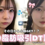 ｜美容整形VLOG｜顔の脂肪吸引+糸リフトで理想の小顔を手に入れてきました👧🏻‎ ✨️施術当日の様子🐮DT14日間の経過まとめ🪄︎︎