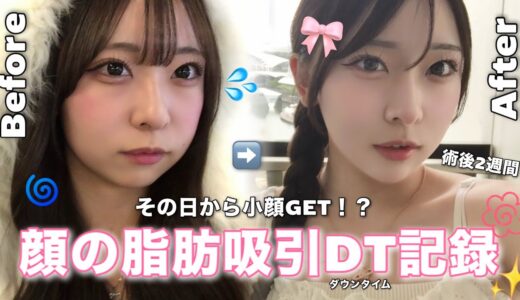 ｜美容整形VLOG｜顔の脂肪吸引+糸リフトで理想の小顔を手に入れてきました👧🏻‎ ✨️施術当日の様子🐮DT14日間の経過まとめ🪄︎︎