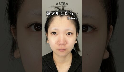 鼻フルしたら･･･🫢❤️#astrabeautyclinic  #アストラビューティークリニック #塩満恵子 #鼻整形 #美容整形 #忘れ