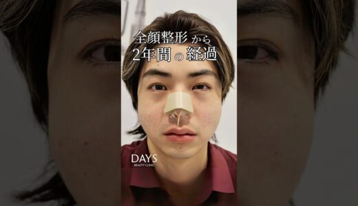 【全顔整形】フル整形から2年の経過！#shorts