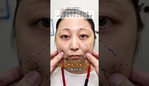 【小顔整形】下膨れってなくなる？#shorts