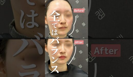 整形成功の鍵はまず輪郭形成から！#脂肪注入 #脂肪移植 #脂肪吸引 #脂肪吸引注射 #美容 #美容整形 #整形 #輪郭整形 #小顔 #垢抜け #shorts