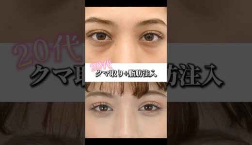 20代クマ取り➕脂肪注入　#湘南美容クリニック船橋院　#クマ取り #クマ取りといえば大野 #湘南美容クリニック #美容 #整形　#shorts