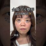 【老け顔解消！？全顔フル整形で別人に🥹#忘れ鼻#鼻整形#垢抜け#二重埋没法#くま取り#美容整形#塩満先生#アストラビューティークリニック#astrabeautyclinic#渋谷】