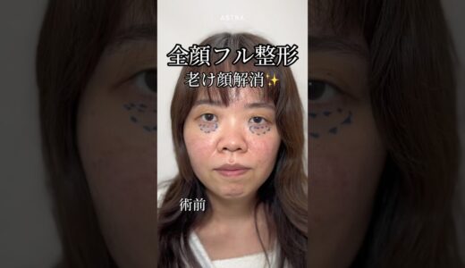 【老け顔解消！？全顔フル整形で別人に🥹#忘れ鼻#鼻整形#垢抜け#二重埋没法#くま取り#美容整形#塩満先生#アストラビューティークリニック#astrabeautyclinic#渋谷】