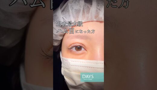 【二重整形】他院でハム目に！？#shorts