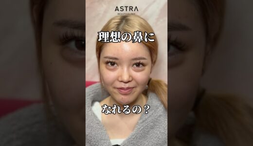 理想の鼻になる？😍✨#astrabeautyclinic  #アストラビューティークリニック #塩満恵子 #鼻整形 #美容整形 #忘れ鼻