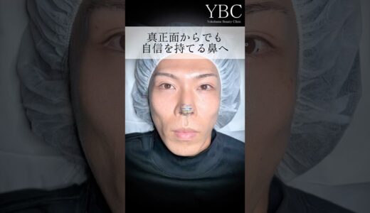 鼻整形で内面まで変われます【鼻整形】#美容 #美容整形 #整形 #鼻整形
