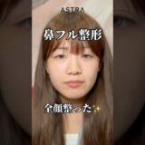 鼻フルすると🥸✨#astrabeautyclinic  #アストラビューティークリニック #塩満恵子 #鼻整形 #美容整形 #忘れ鼻