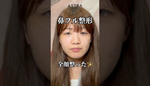 鼻フルすると🥸✨#astrabeautyclinic  #アストラビューティークリニック #塩満恵子 #鼻整形 #美容整形 #忘れ鼻