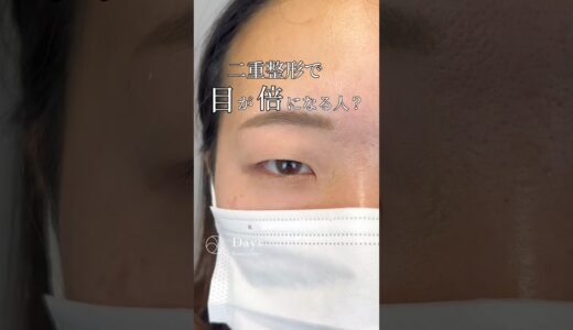 【二重整形】整形で目が倍に？！#shorts