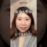 鼻フル整形でどうなる？😳✨#astrabeautyclinic  #アストラビューティークリニック #塩満恵子 #鼻整形 #美容整形 #忘れ鼻