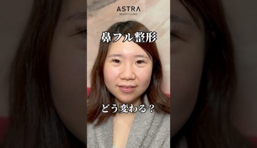 鼻フル整形でどうなる？😳✨#astrabeautyclinic  #アストラビューティークリニック #塩満恵子 #鼻整形 #美容整形 #忘れ鼻
