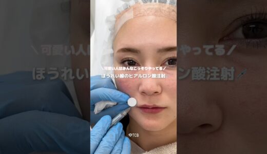 【美容整形】ほうれい線のヒアルロン酸で激変‼️#shorts