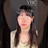 鼻先だけでこれだけ変わる【鼻整形】#鼻整形 #整形 #美容整形 ＃別人