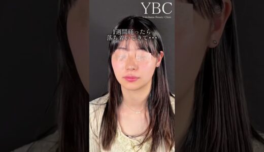 鼻先だけでこれだけ変わる【鼻整形】#鼻整形 #整形 #美容整形 ＃別人