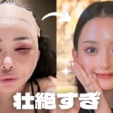切開リフト眉骨アイホールボーン削りしてきた