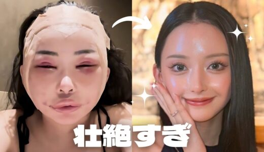 切開リフト眉骨アイホールボーン削りしてきた