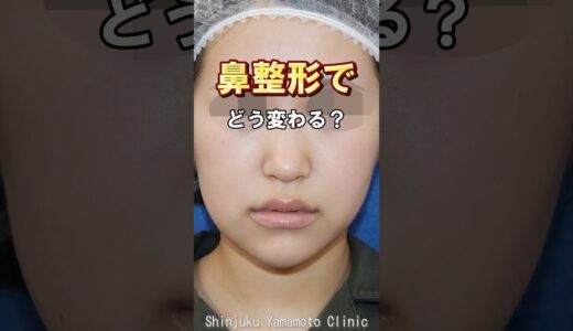 移植物なしで鼻整形ってどうなの？　#鼻整形 #美容整形 #他院修正 #小鼻縮小 #shortvideo #新宿山本クリニック #鼻尖形成 #鼻中隔延長 #鼻フル #shorts #short