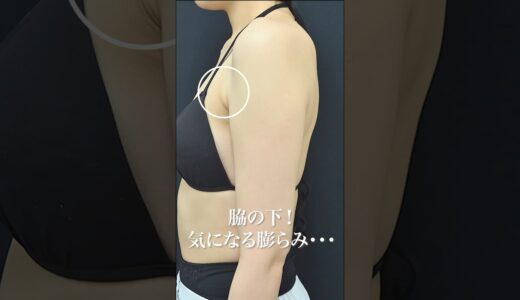 脇の下の膨らみは〇〇って知ってましたか？#湘南美容クリニック名古屋院 #美容 #美容整形 #副乳 #脂肪吸引 #ノースリーブ