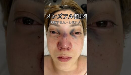 【一体何をしたの⁉️フル整形3ヶ月後の経過お見せします😌#忘れ鼻#鼻整形#ホスト#ホスト整形#メンズ整形#垢抜け#塩満先生#アストラビューティクリニック #astrabeautyclinic#渋谷】