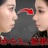整形から3ヶ月…横顔が別人に！？ | AB美容整形