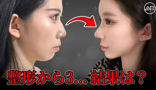 整形から3ヶ月…横顔が別人に！？ | AB美容整形