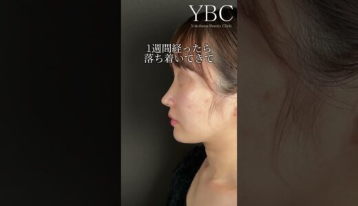 YBC式人気な鼻整形【術後３ヶ月まで一気見せ】#美容 #整形 #鼻整形