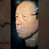 【美容整形】眉下の皮膚を切ると…#shorts