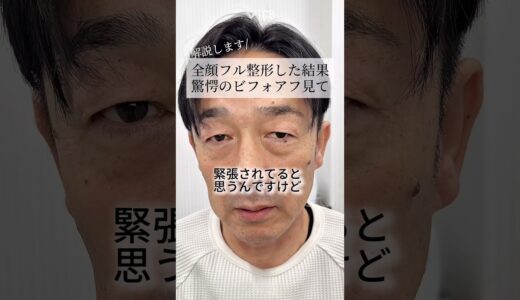 【クマ取り】全顔フル整形した結果。驚愕のビフォアフ見て#shorts