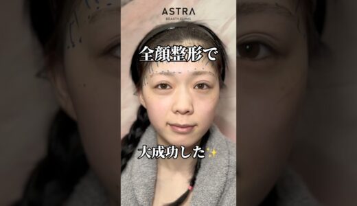 全顔整形で大成功💖#astrabeautyclinic  #アストラビューティークリニック #塩満恵子 #鼻整形 #美容整形 #忘れ鼻