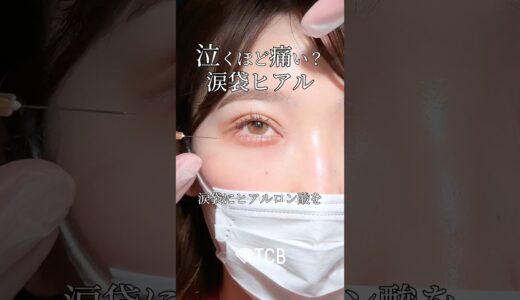 【美容整形】泣くほど痛い？涙袋ヒアル💧#shorts