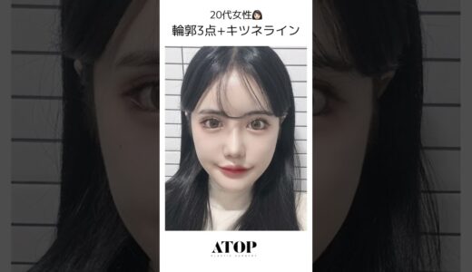輪郭3点+キツネライン  #エートップ美容整形外科 #輪郭整形#キツネライン