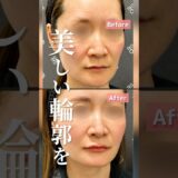 輪郭が命です。#脂肪注入 #脂肪移植 #脂肪吸引 #脂肪 #脂肪吸引注射 #輪郭整形 #頬コケ #美容 #美容整形 #整形 #小顔 #shorts