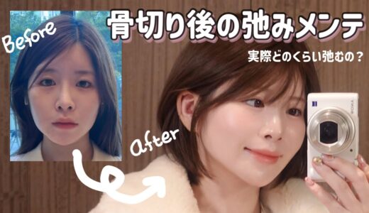 【美容整形】骨切り手術したらめっちゃ弛んだからメンテナンスしたら更に顔小さくなった【輪郭3点】