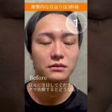 【男性のクマ治療】劇的ビフォーアフター#クマ取り #美容整形 #目の下のクマ #shorts