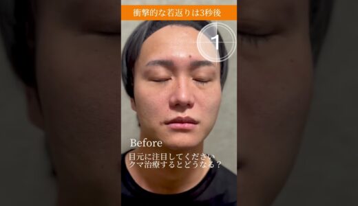 【男性のクマ治療】劇的ビフォーアフター#クマ取り #美容整形 #目の下のクマ #shorts