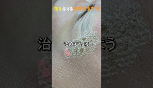 皮膚美容のためのCO2レーザー