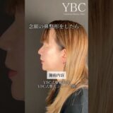鼻整形の経過３ヶ月まで全見せ！