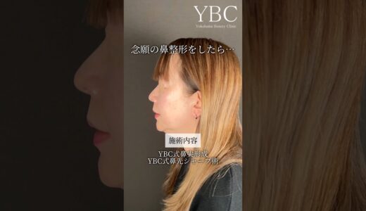 鼻整形の経過３ヶ月まで全見せ！
